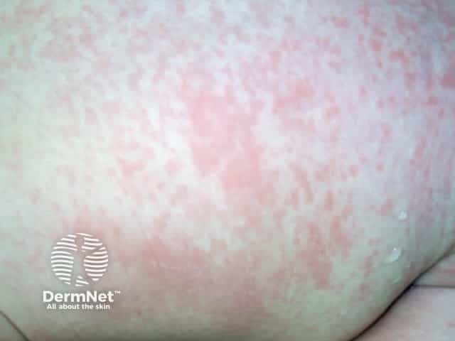 Bambino con esantema da rosolia (dettaglio)