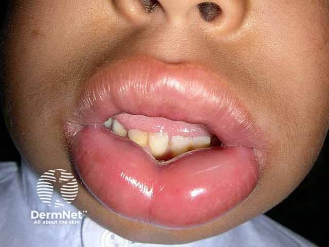 Bambino con grave angioedema allle labbra