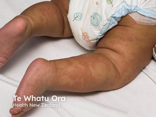 Come appare l'orticaria sulla pelle nera