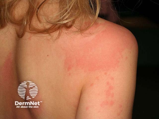 Bambina con orticaria