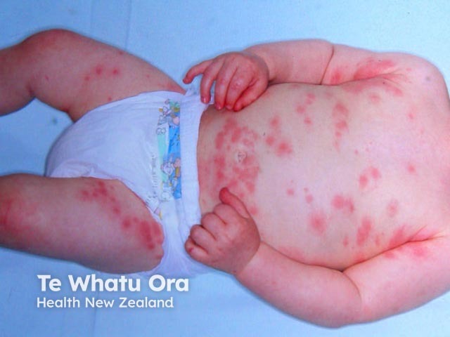 Bambino piccolo con orticaria