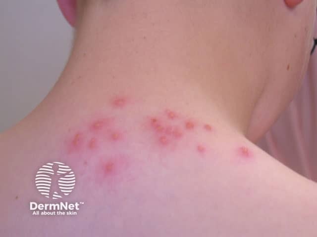 Orticaria papulare