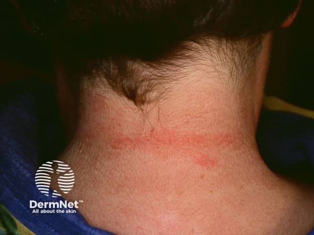 Orticaria da pressione