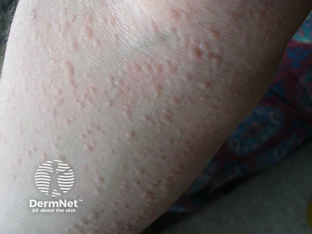 Orticaria da freddo