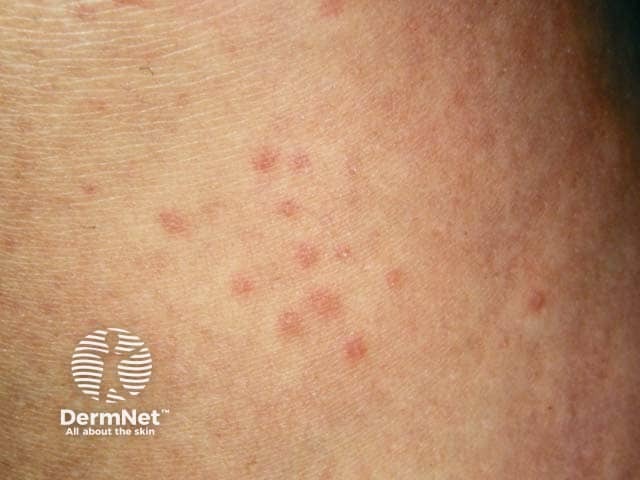 Orticaria colinergica
