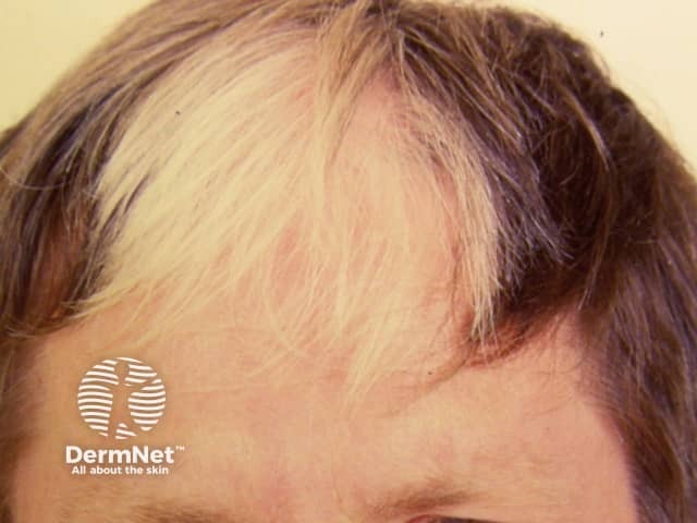 https://dermnetnz.org/topics/piebaldism
