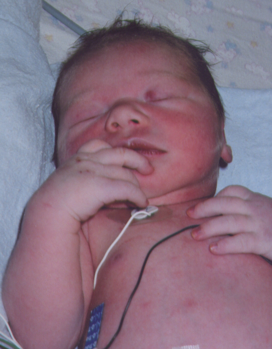 Neonato cianotico con labbra bluastre