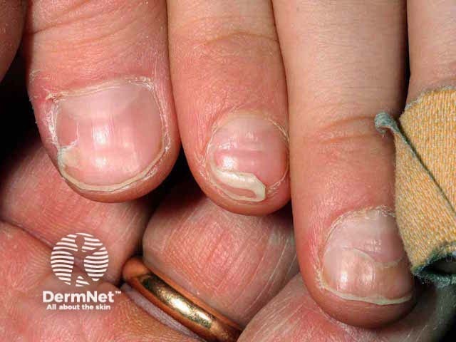 lesioni sulle unghie comparse a 6 settimane dalla risoluzione delle lesioni orali e cutanee da mani piedi bocca