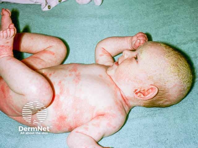 Dermatite seborroica infantile con tipica crosta lattea e pelle eritematosa e arrossata anche nella zona delle ascelle e del pannolino.