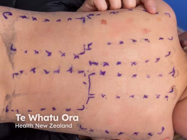 Patch test per dermatite allergica da contatto