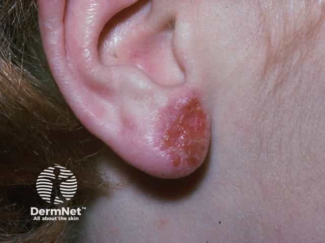 Dermatite allergica da contatto nella zona del lobo auricolare