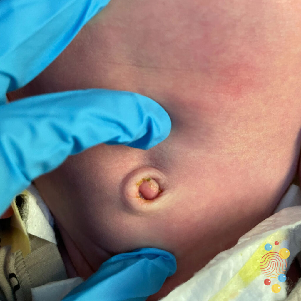 Neonato con granuloma ombelicale
