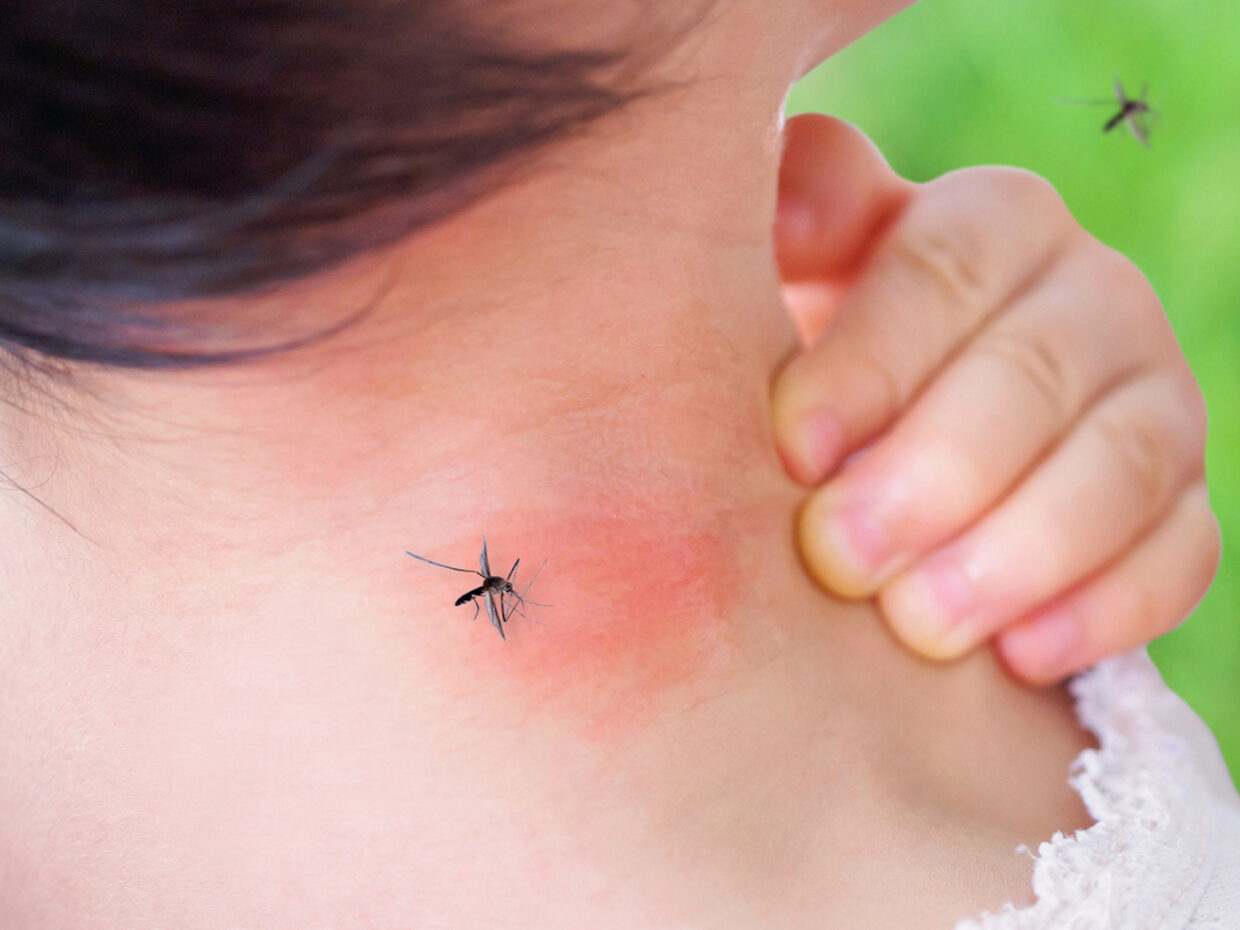West Nile Virus e zanzara sul collo di una bambina