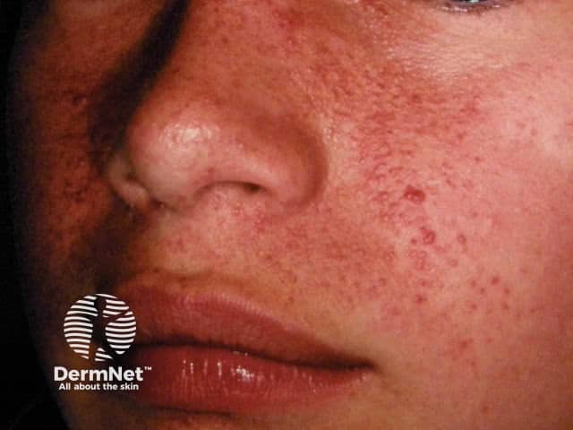 Angiofibromi sul viso di un soggetto affetto da sclerosi tuberosa