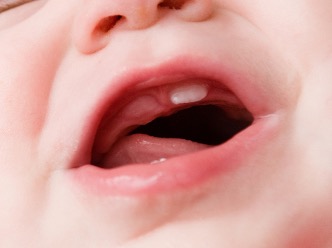 Gengiva gonfia e arrossata per un dentino incisivo in eruzione