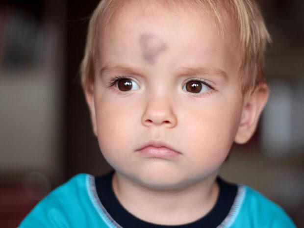 Traumi cranici nei bambini