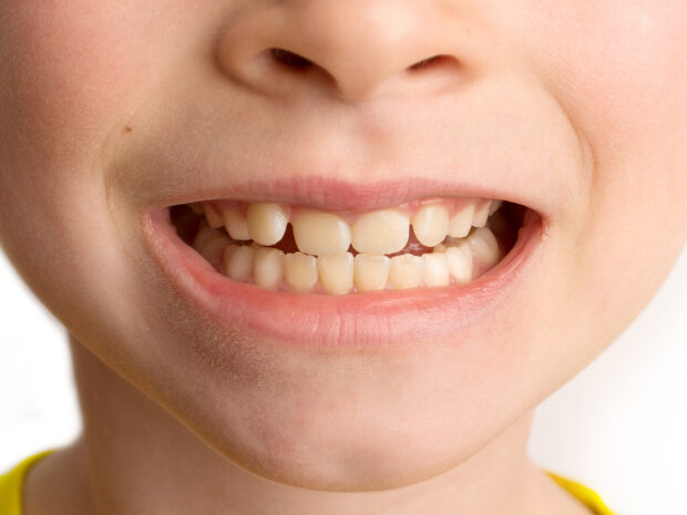 Bambina con denti permanenti più gialli dei denti da latte